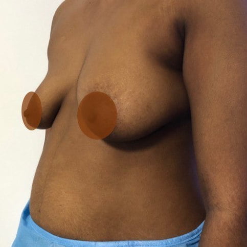 breast before