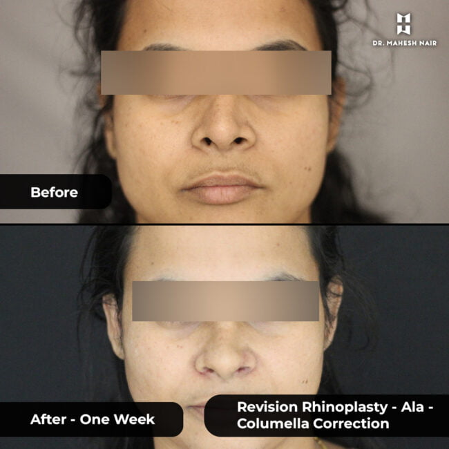 Deepa Biju rhinoplasty 1-01