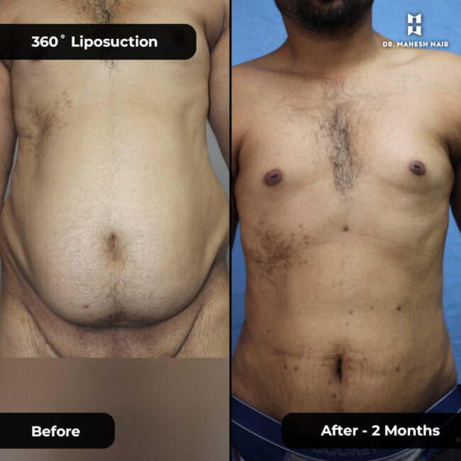 Habeeb torso liposuction 1-01