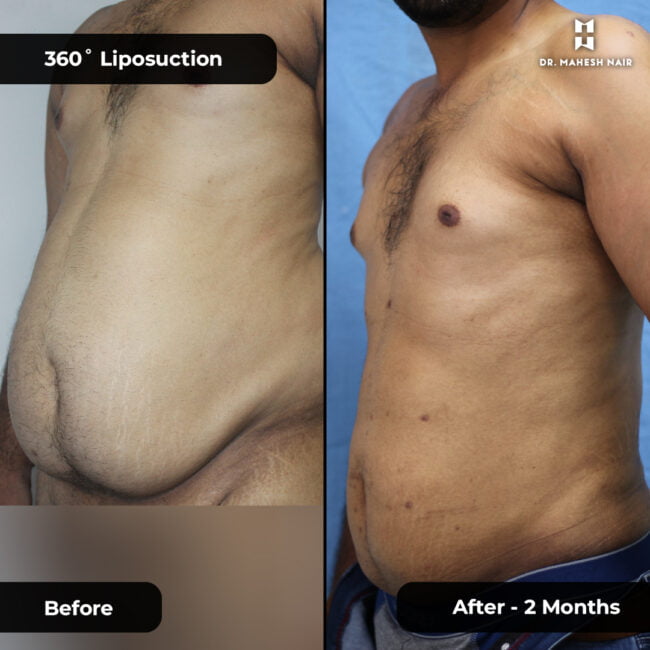 Habeeb torso liposuction 2-01