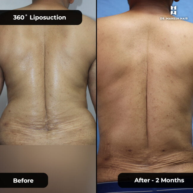 Habeeb torso liposuction 6-01