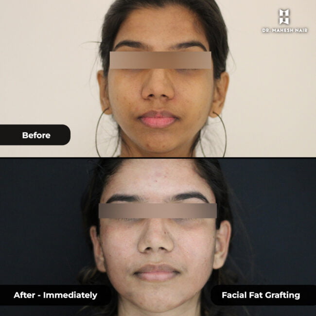 Kavitha Rajendran FFG (Facial fat grafting) 1-01