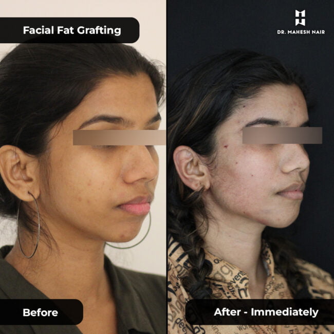 Kavitha Rajendran FFG (Facial fat grafting) 4-01
