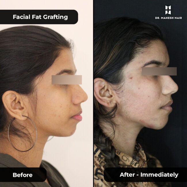 Kavitha Rajendran FFG (Facial fat grafting) 5-01