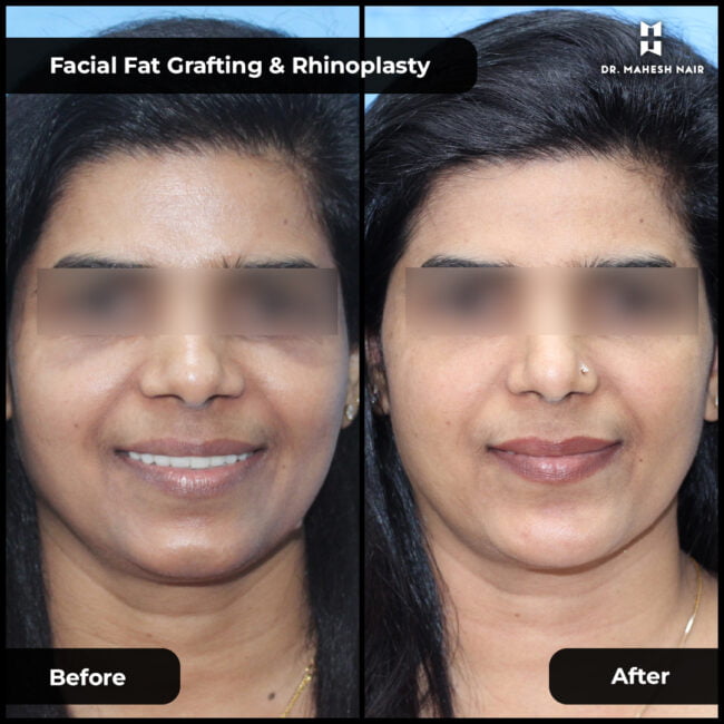 Periorbiotal rejuvenation or facial fat grafting-01