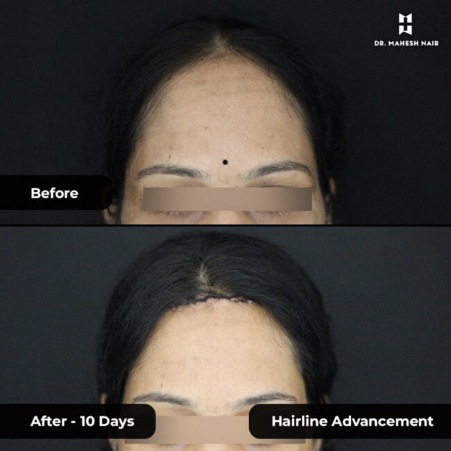Rekha reshmi hairline advancement 1-01