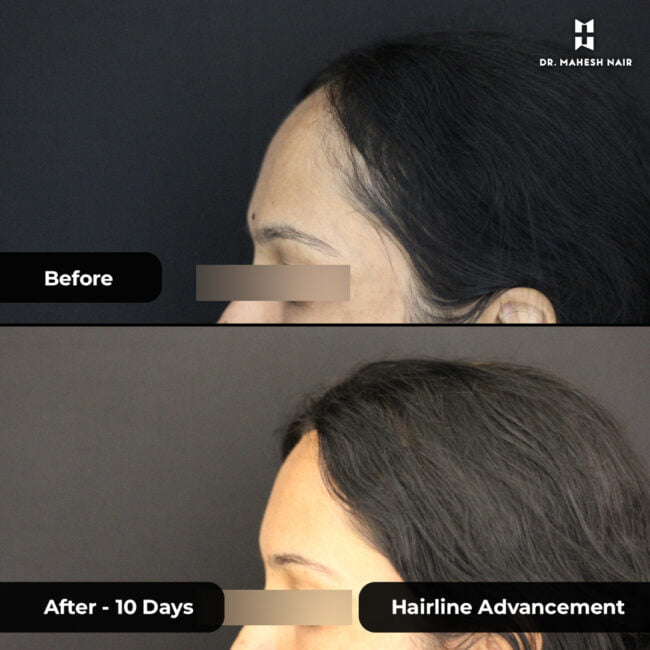 Rekha reshmi hairline advancement 3-01