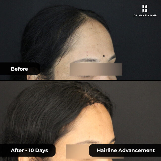 Rekha reshmi hairline advancement 4-01