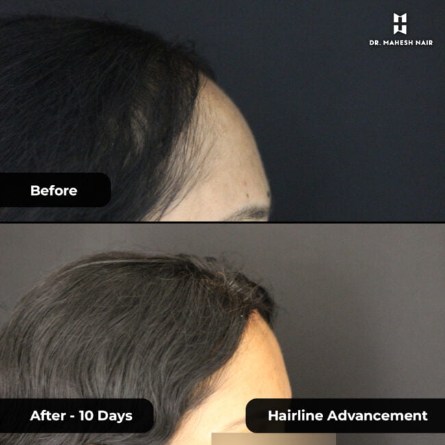 Rekha reshmi hairline advancement 5-01